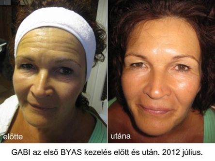 Botox, hialuronsav, ráncfeltöltés - dr. Bulyovszky István, PERFECT YOU Plasztikai Sebészet